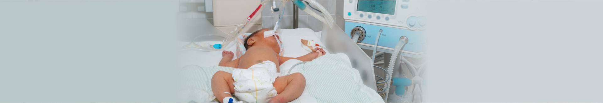 Newborn baby with hyperbilirubinemia on breathing machine or ventilator with pulse oximeter sensor and peripheral intravenous catheter in neonatal intensive care unit at children's hospital